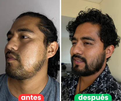 Bálsamo para Crecimiento de Barba Ultra Potente con Minoxidil 20% | 100mL 👊